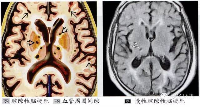 陈旧性腔隙性脑梗死多表现为边缘锐利,形态多样的病灶