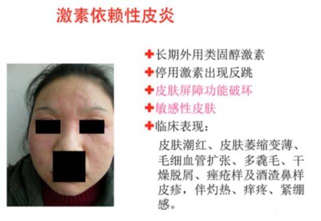 药膏,可以抑制皮炎症状,短期抑制激素依赖性皮炎皮肤反复受到侵害的