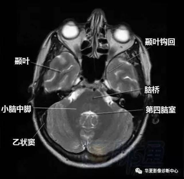 脑部断层 内囊 willis环 前联合 垂体 海马:清晰解剖图谱