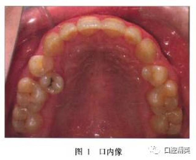 上颌前磨牙腭中缝异位伴颏部多生牙1例