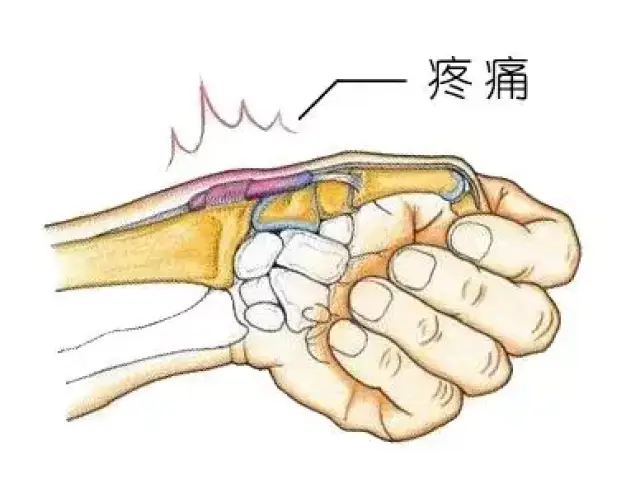此时拇指根部处出现剧痛,就是握拳尺偏试验(finkelstein征)阳性,基本