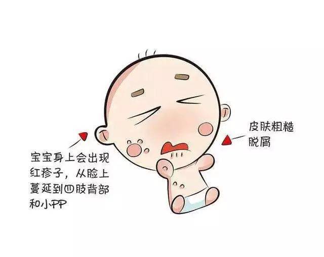 【瑞博儿科】育儿经——正确认识儿童湿疹