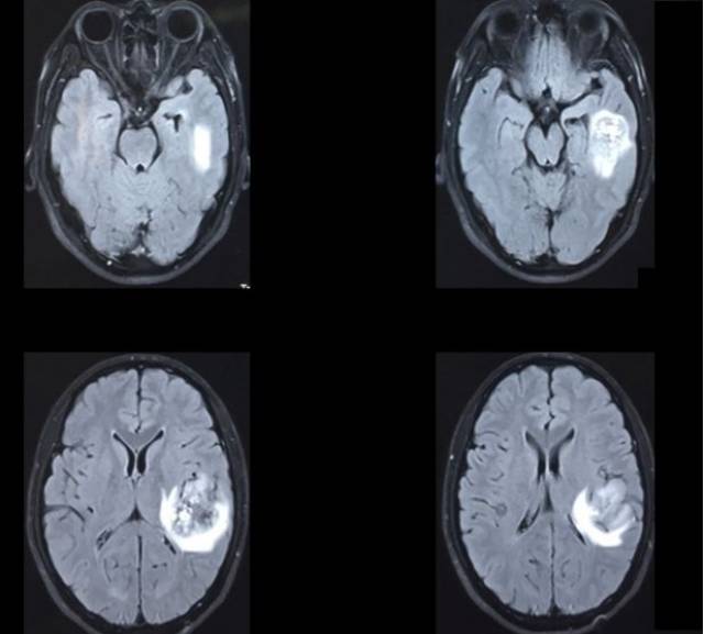 术前颅脑mri t2flair图像,示左颞叶团块状低信号为主混杂信号影,周围