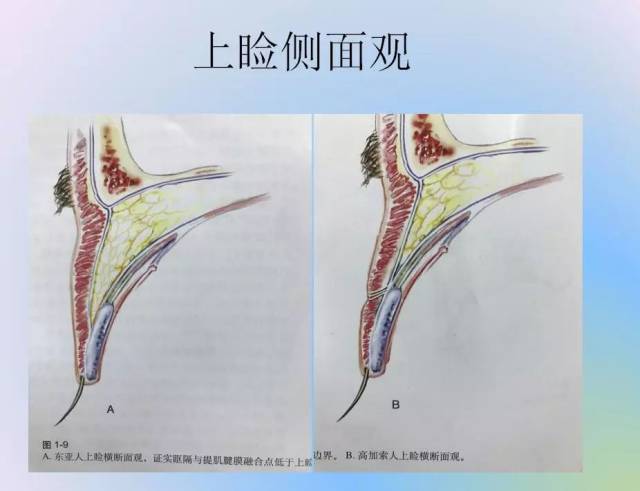 一横行皮肤皱襞,又称 重睑