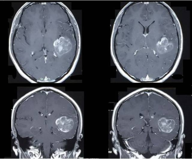 上皮样胶质母细胞瘤一例(2018华东胶质瘤mdt病例二)