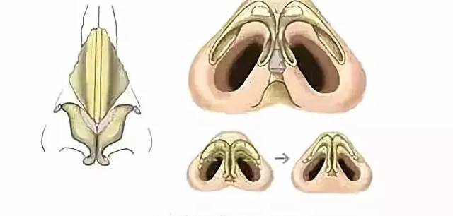 科普|鼻整形手术后怎样恢复的更快?