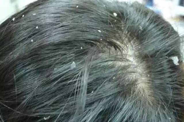 出现头皮屑且头皮发痒是在告诉你什么?