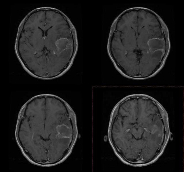 上皮样胶质母细胞瘤一例(2018华东胶质瘤mdt病例二)