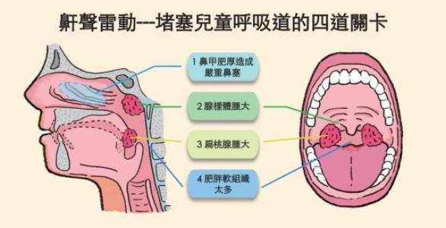 首大石萍:腺样体肥大是儿童鼾症的主因