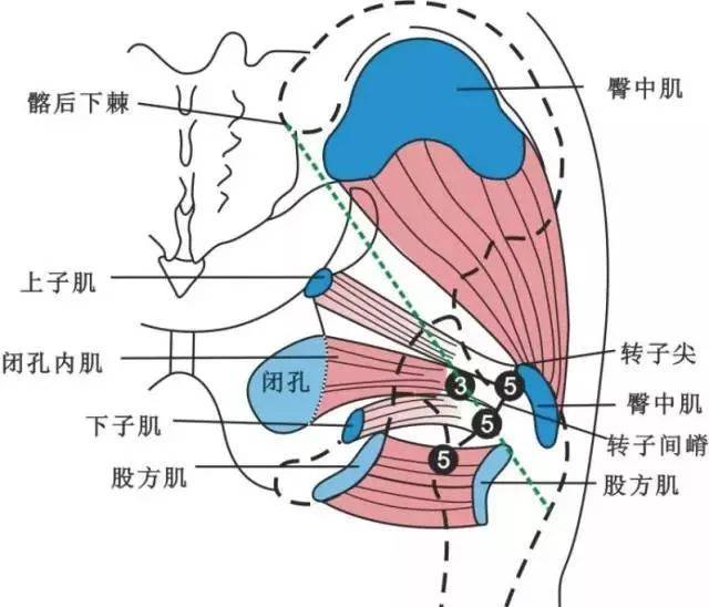 股骨头坏死针刀治疗精要