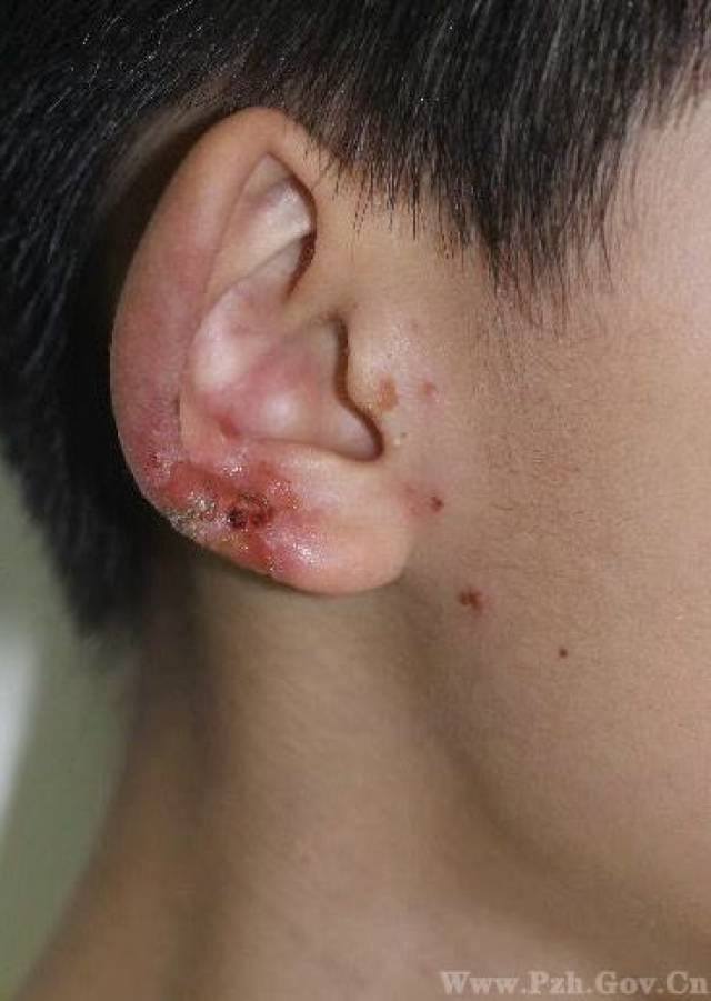 小患者耳朵上长了脓疱疮.