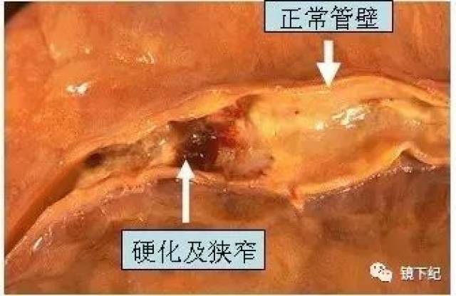 冠状动脉粥样硬化伴粥样斑块内出血.