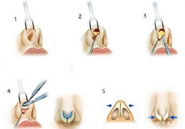 鼻中隔软骨优势