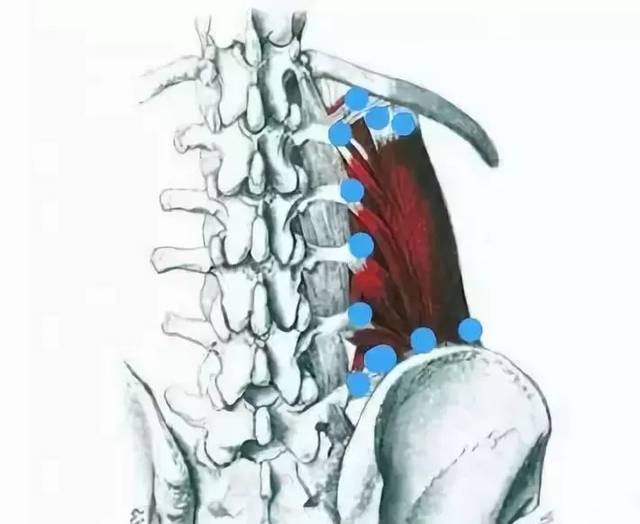 腰方肌定点示意图