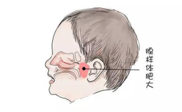 石萍:小孩牙齿不齐的另一个原因"腺样体肥大"