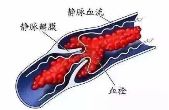 血栓栓塞是一种由于动脉或静脉中形成了血凝块而导致的潜在的致死性