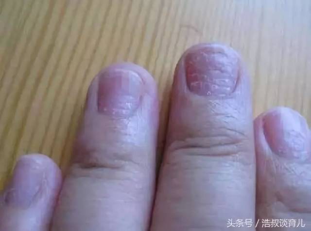 3,如宝宝手指甲真感染上真菌,可采用以下治疗方法:轻轻削除病甲,外擦
