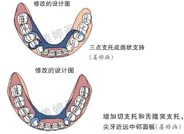 上颌前牙舌隆突支托未形成 牙合力