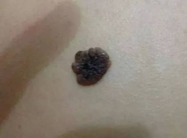 【健康】一颗黑痣没注意,28岁女子惹癌上身!身上长这5