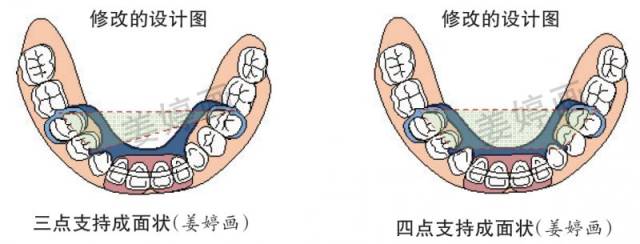 上颌前牙舌隆突支托未形成 牙合力中止,义齿下沉并推基牙向前移动