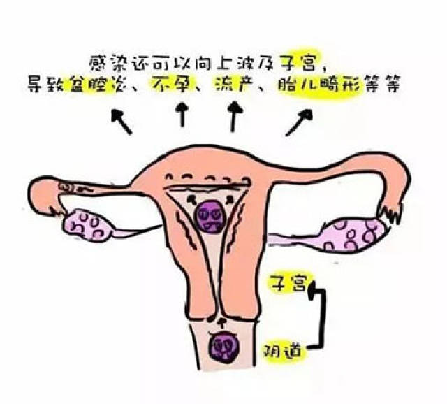 妇科炎症知多少,如何对付阴道炎,宫颈糜烂,盆腔炎?