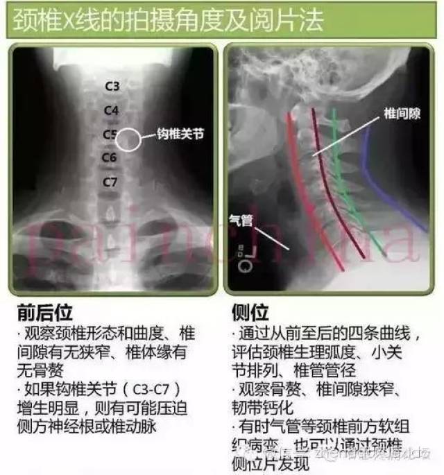 请输入描述  (15)腰椎斜位片