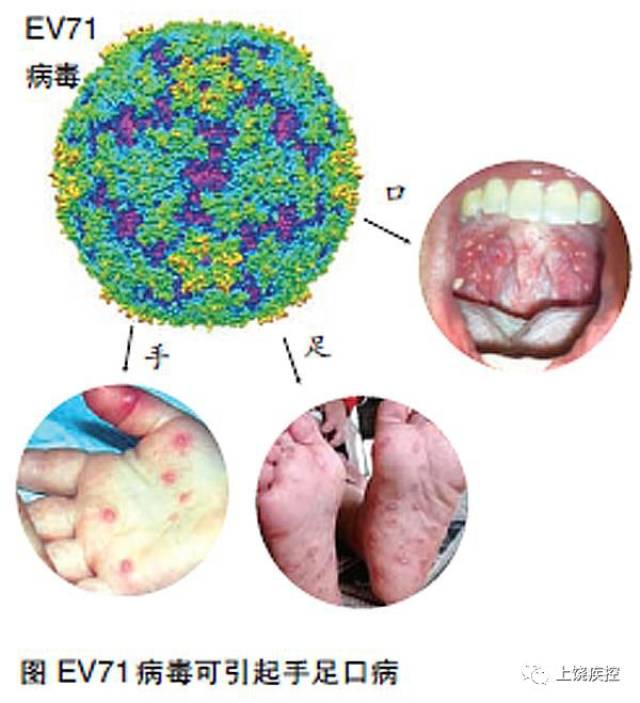 ev71是人类肠道病毒的一种,可引起多种疾病,其中手足口病最为常见,可