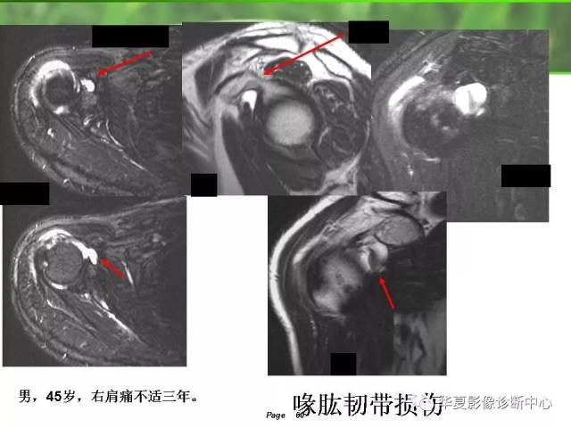 肩关节解剖及常见病变的mri诊断