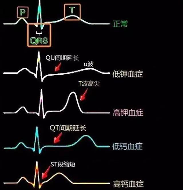 15.电解质紊乱的典型心电图表现