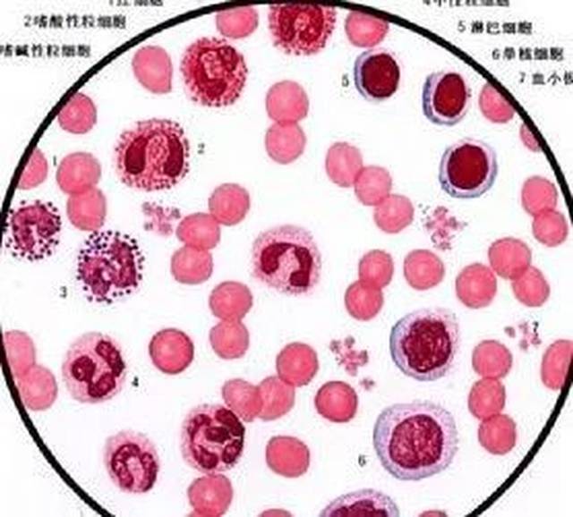 骨髓增生异常综合症的诊断标准以及鉴别