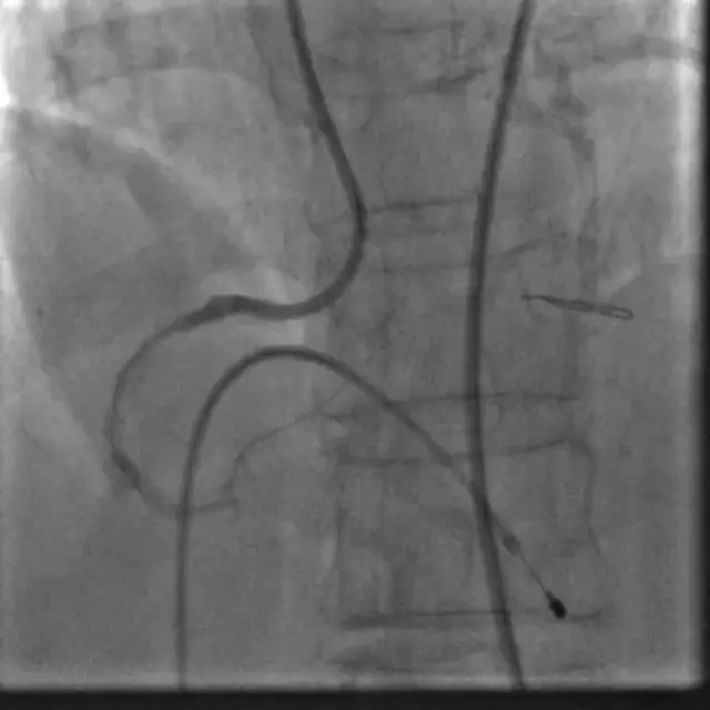老人冠状动脉严重钙化 国内外专家合力成功旋