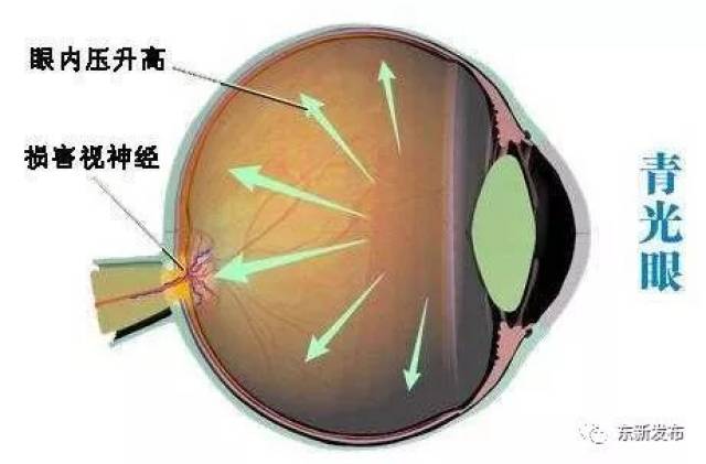 开角型青光眼和闭角型青光眼是老年人常见的两种青光眼疾病.