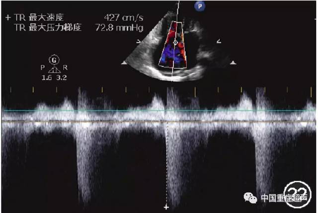 23a 心尖四腔心平面心室舒张期 23b 心尖四腔心平面心室收缩期 23c