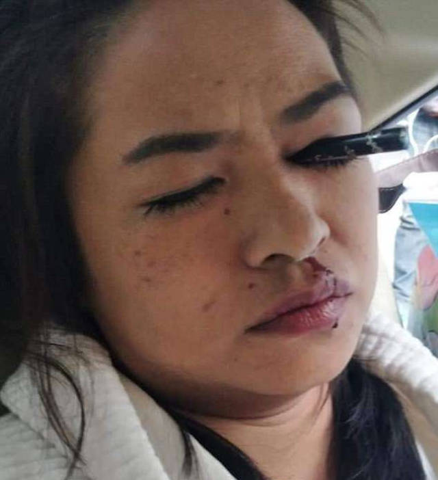 出租车追尾致女乘客眼线笔插入眼睛