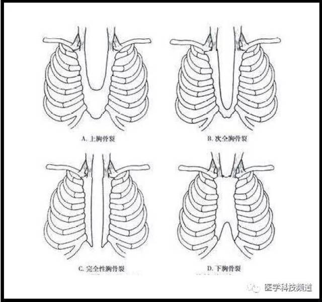 出生30天宝宝的超级手术:重度胸骨裂 先心病手术