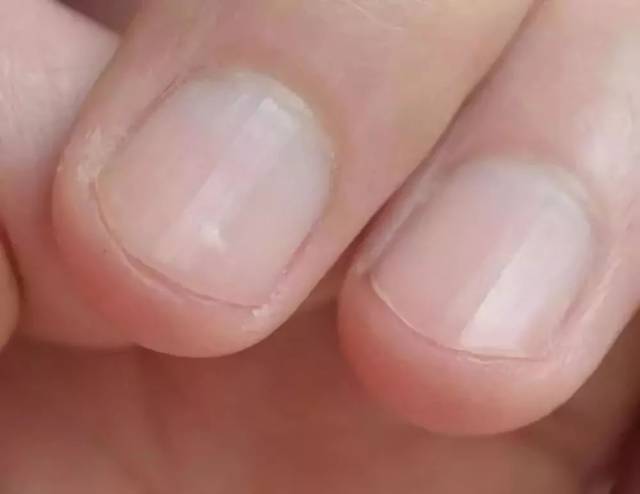 涨知识指甲上有竖条纹是肝不好月牙越多越健康指甲的2个真相