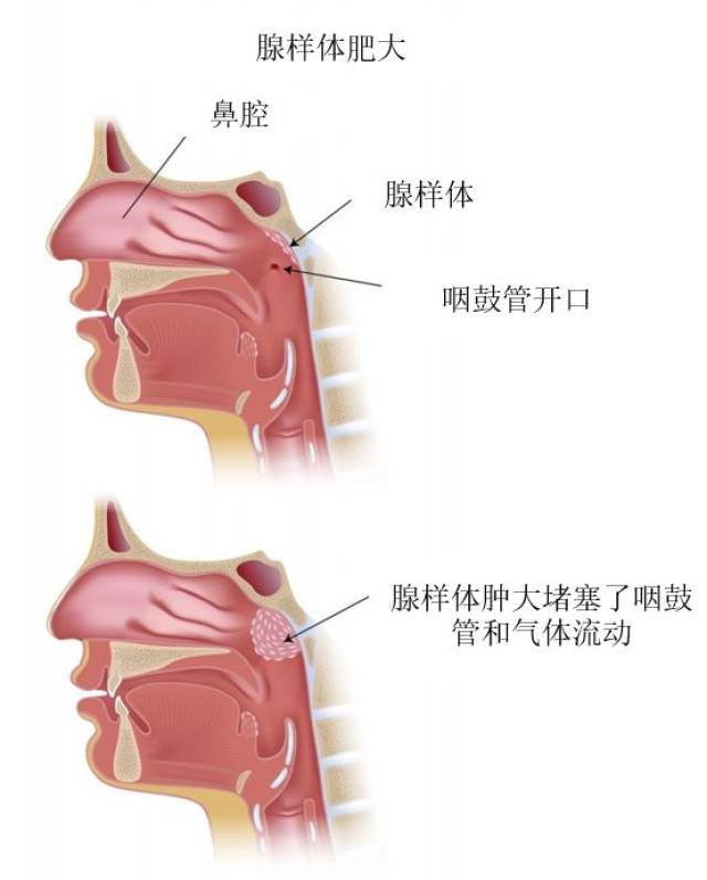腺样体,是位于鼻子和喉咙之间的块状组织(如下图所示).