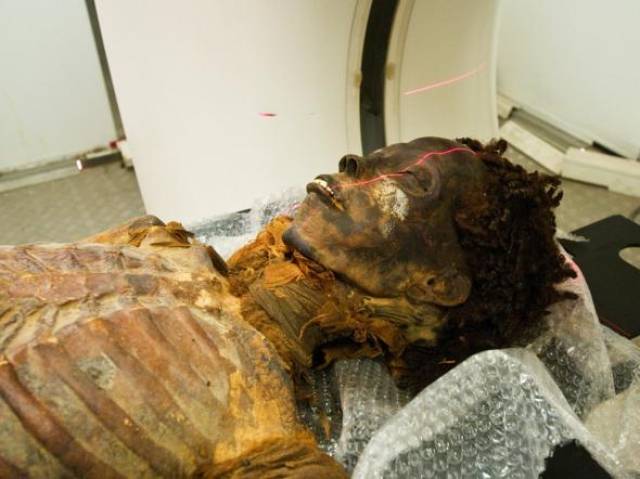 对2000多年前的马王堆辛追夫人古尸进了行解剖,发现这位肥胖的老妇人