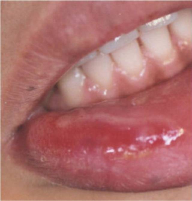 口腔黏膜斑(边缘平坦或稍隆起,临床上应注意和白斑鉴别 表3 二期
