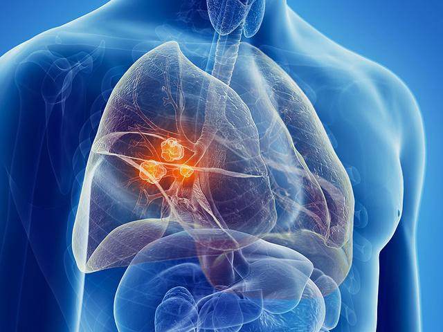 这几个症状竟然是肺癌早期症状,却被我们忽视!