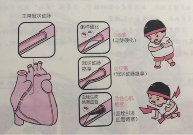 简单易懂的冠心病完全图解!