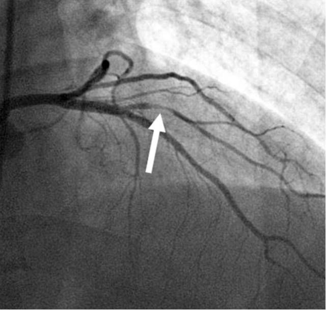 造影显示,箭头所指心脏血管处出现狭窄