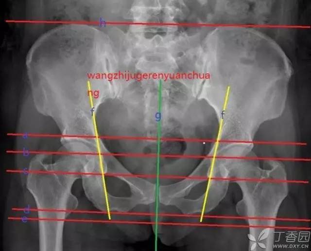 据说只有 1% 骨科医生能完全读懂骨盆 x 线片,不信你来试试