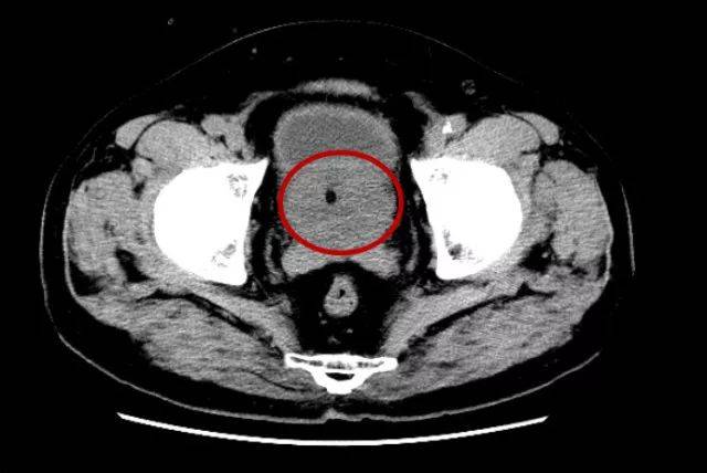 ct示前列腺增生↑ 膀胱镜下前列腺两侧叶明显增大
