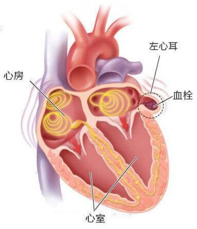 房颤——会引起中风,心衰的心脏病