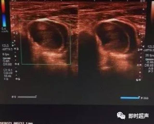 【病例】腹部疝超声诊断