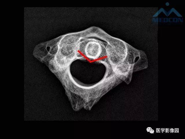 寰枢关节脱位的影像诊断