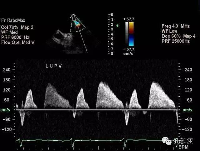 入院食管超声提示左上肺静脉前向血流明显加速