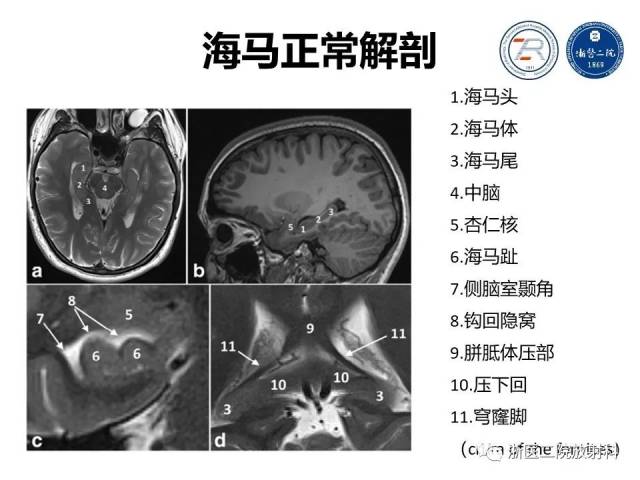 文献学习 | 海马正常解剖及病变介绍