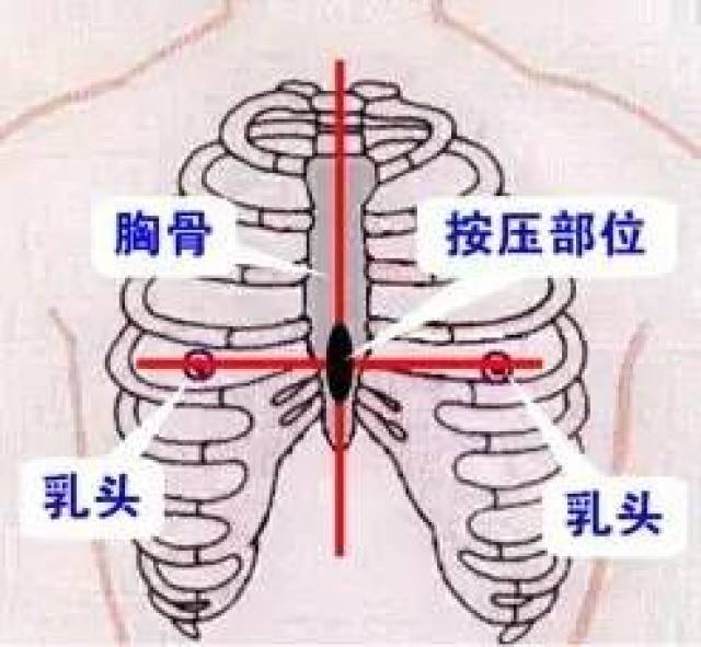 横纵两线交汇处,就是心脏按压点[1](图 1).